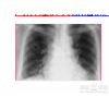全套肺间质性肺炎：陕西放心的肺间质性肺炎治疗