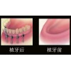 周到的廊坊牙齿种植推荐，廊坊牙齿矫正价格