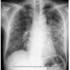 陕西一流的肺纤维化治疗推荐：肺纤维化报价