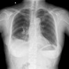 西安肺大泡——一流的肺大泡治疗推荐