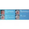爆款小儿耳廓矫正器北京提供-中国小儿耳廓矫正器